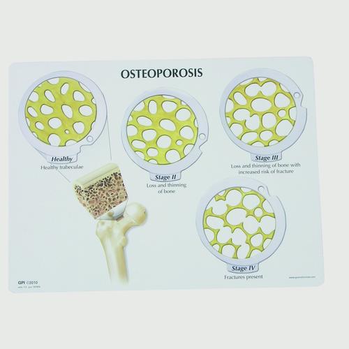 Jeu de disques de cancer osseux - 4 stades d’ostéoporose, 1019509, Modèles de vertèbres