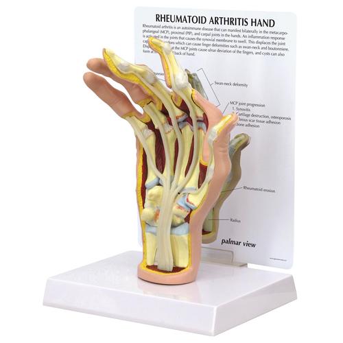 Modèle de main avec arthrite rhumatoïde, 1019521, Squelettes des membres supérieurs