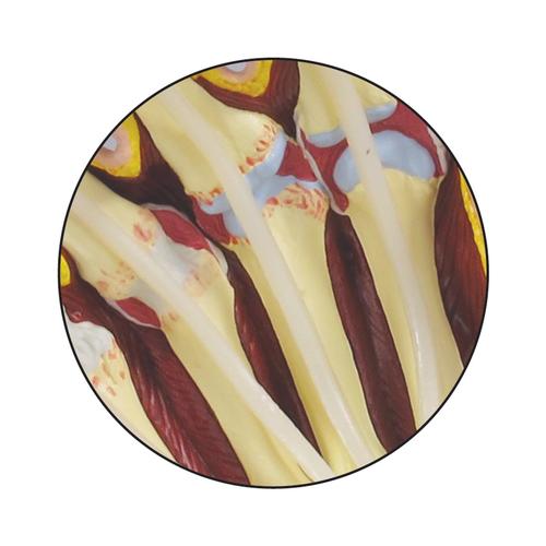 Modèle de main avec arthrite rhumatoïde, 1019521, Squelettes des membres supérieurs