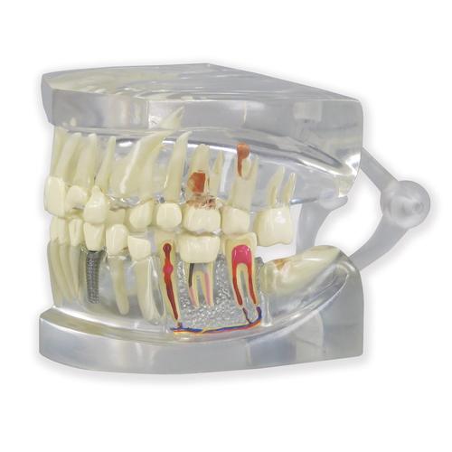 Mâchoire humaine transparente avec modèle dentaire, 1019540, Modèles dentaires