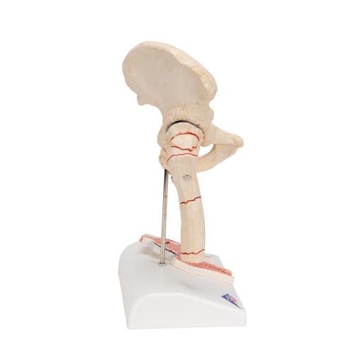 Fracture du fémur et usure de l'articulation de la hanche - 3B Smart Anatomy, 1000175 [A88], Éducation Arthrite et Ostéoporose