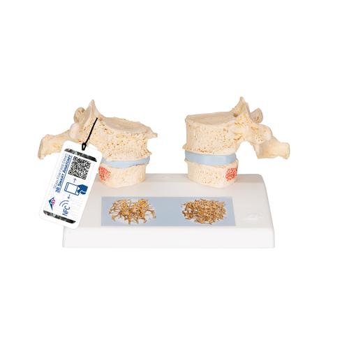 Modèle d'ostéoporose - 3B Smart Anatomy, 1000182 [A95], Colonnes vertébrales (rachis)