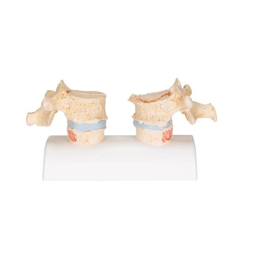 Modèle d'ostéoporose - 3B Smart Anatomy, 1000182 [A95], Colonnes vertébrales (rachis)