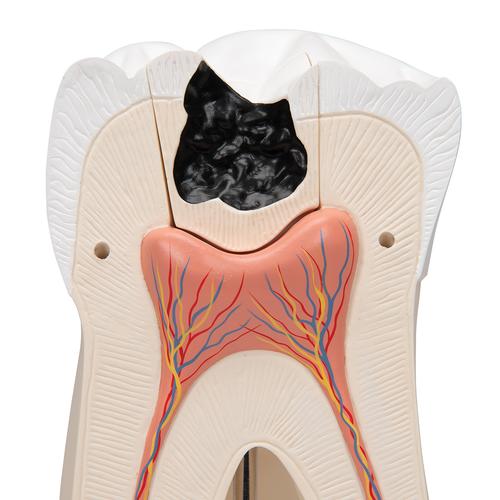 Molaire supérieure à trois racines, en 6 parties (avec carie) - 3B Smart Anatomy, 1013215 [D15], Modèles dentaires