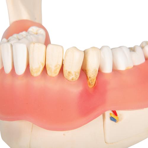 Affection dentaire, agrandissement : 2 fois, 21 pièces - 3B Smart Anatomy, 1000016 [D26], Modèles dentaires