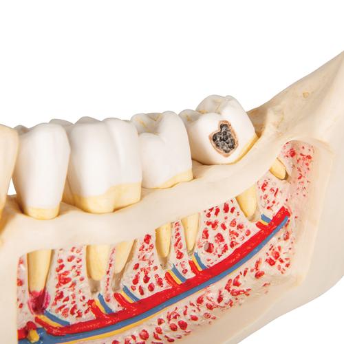 Affection dentaire, agrandissement : 2 fois, 21 pièces - 3B Smart Anatomy, 1000016 [D26], Modèles dentaires