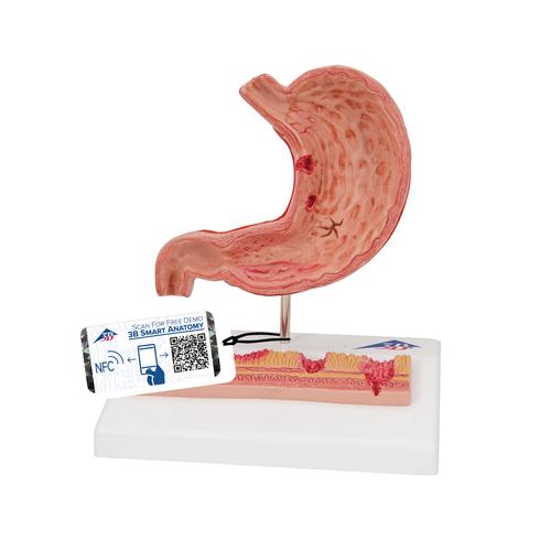 Estomac avec ulcères gastriques - 3B Smart Anatomy, 1000304 [K17], Modèles de systèmes digestifs