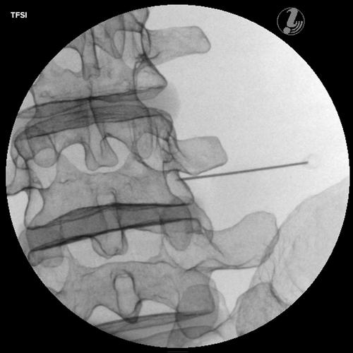 Simulateur d’injection spinale lombaire guidée par l’image P65, 1021898 [P65], Injection et ponction