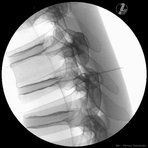 Simulateur d’injection spinale thoracique guidée par l’image P66
, 1021899 [P66], Injection et ponction