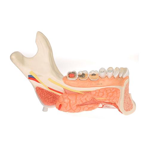 Hémi-mandibule, avec 8 dents cariées, en 19 parties - 3B Smart Anatomy, 1001250 [VE290], Modèles dentaires