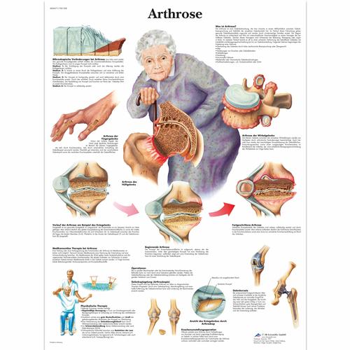 Arthrose, 4006571 [VR0123UU], Éducation Arthrite et Ostéoporose