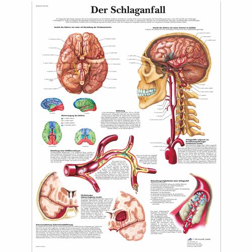 Der Schlaganfall, 4006630 [VR0627UU], système cardiovasculaire