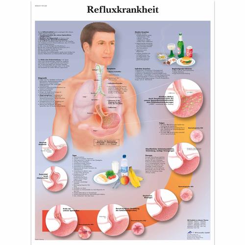 Refluxkrankheit, 4006637 [VR0711UU], Système digestif
