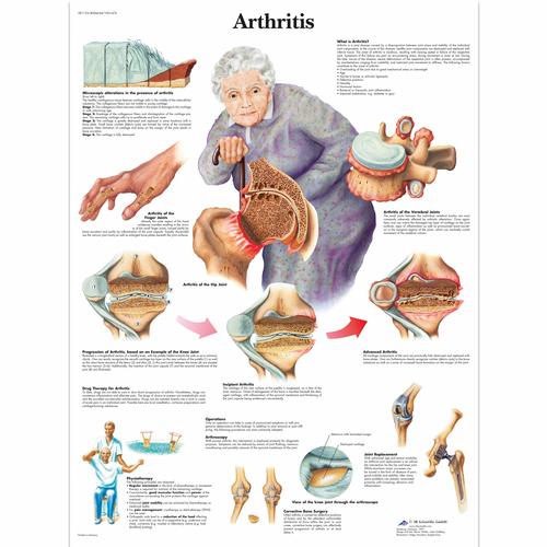 Arthritis, 4006654 [VR1123UU], système Squelettique
