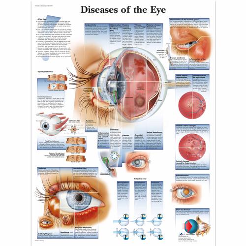 Diseases of the Eye, 4006666 [VR1231UU], Yeux