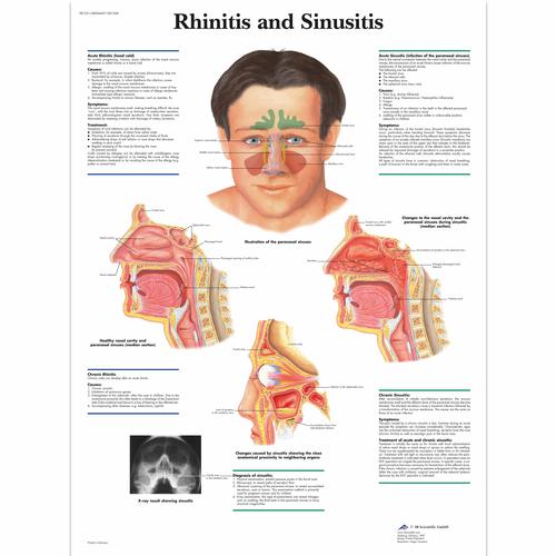 Rhinitis and Sinusitis, 1001504 [VR1251L], Oreille, nez et gorge