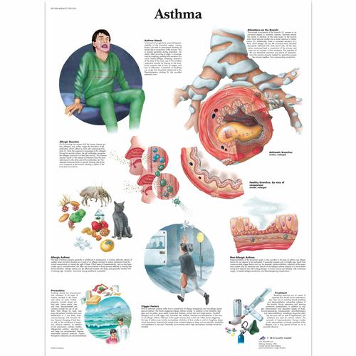Asthma, 4006677 [VR1328UU], Éducation Asthme et Allergies