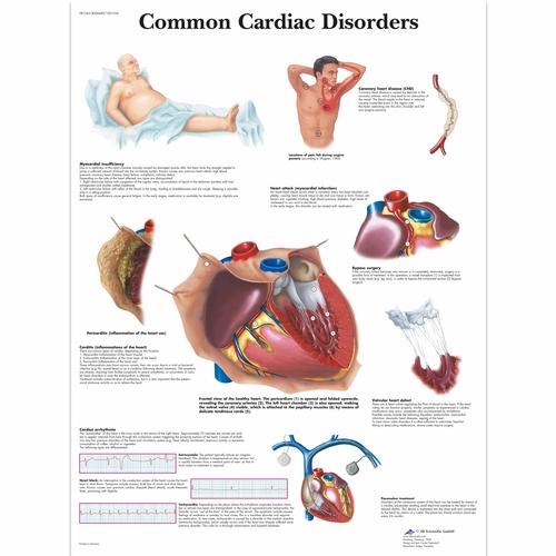 Common Cardiac Disorders, 4006680 [VR1343UU], Éducation Santé du Coeur et Fitness