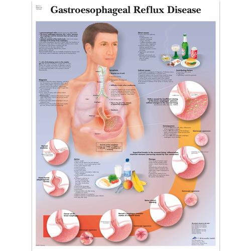 Gastroesophageal reflux disease, 1001602 [VR1711L], Système digestif
