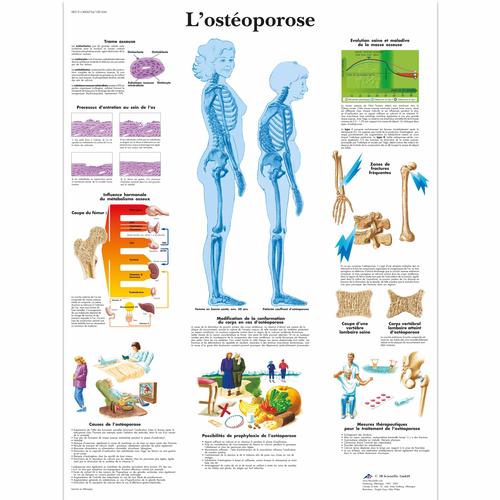 L'ostéoporose, 4006734 [VR2121UU], système Squelettique