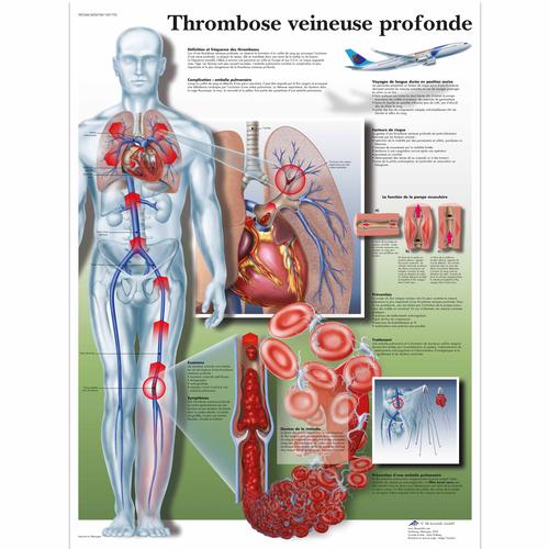 Thrombose veineuse profonde, 4006768 [VR2368UU], système cardiovasculaire