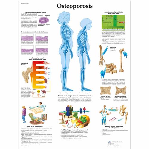 Osteoporosis, 1001803 [VR3121L], Éducation Arthrite et Ostéoporose