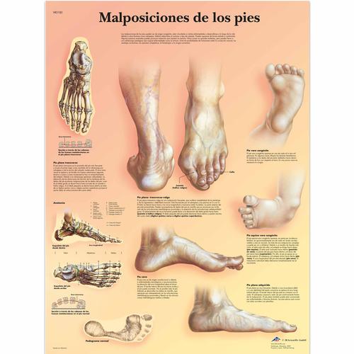 Malposiciones de los pies, 4006826 [VR3185UU], système Squelettique