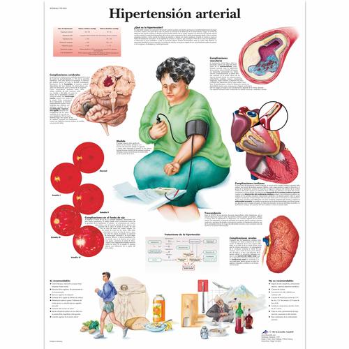 Hipertensión arterial, 4006846 [VR3361UU], système cardiovasculaire