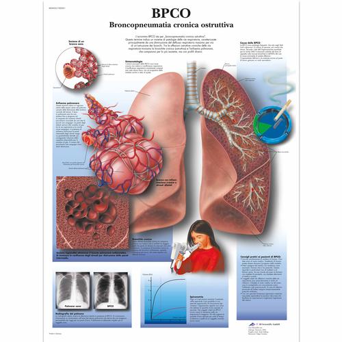 BPCO Broncopneumopatia cronia ostruttiva, 1002021 [VR4329L], Éducation Tabac