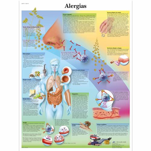 Alergias, 4007011 [VR5660UU], Système immunitaire