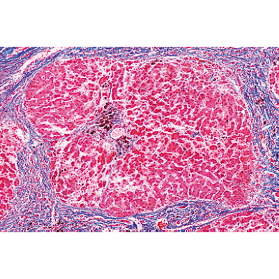 Pathologie humaine série de base - Portugais, 1004096 [W13311P], Préparations microscopiques LIEDER