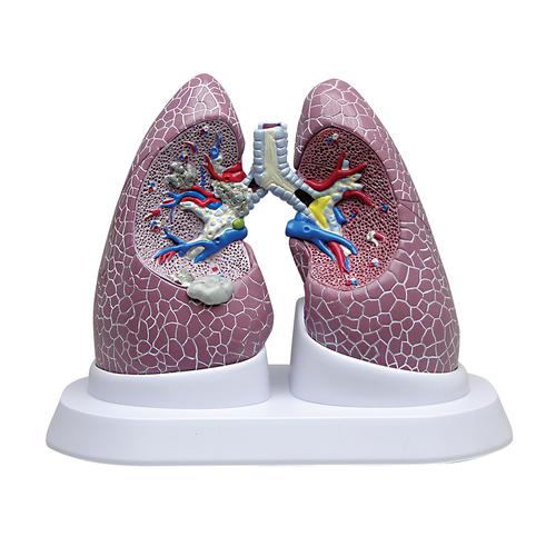 Jeu de poumons avec pathologies, 1018749 [W33371], Modèles de poumons
