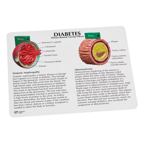 Modèle de diabète en 4 pièces, 1019574 [W33387], Outils d’éducation au diabète
