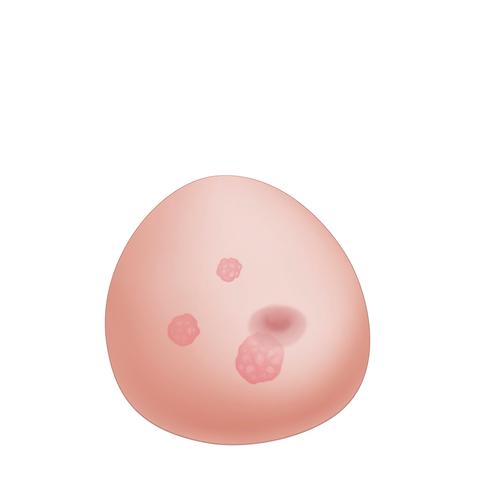 Modèle de sein échographique avec tumeurs SONOtrain – Sein de rechange, 1019650 [XP125], Consommables