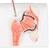 Fracture du fémur et usure de l'articulation de la hanche - 3B Smart Anatomy, 1000175 [A88], Éducation Arthrite et Ostéoporose (Small)