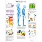  Osteoporose, 4006570 [VR0121UU], Éducation Arthrite et Ostéoporose