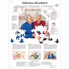 Alzheimer-Krankheit, 1001428 [VR0628L], Cerveau et système nerveux