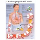 Gastroesophageal reflux disease, 1001602 [VR1711L], Système digestif
