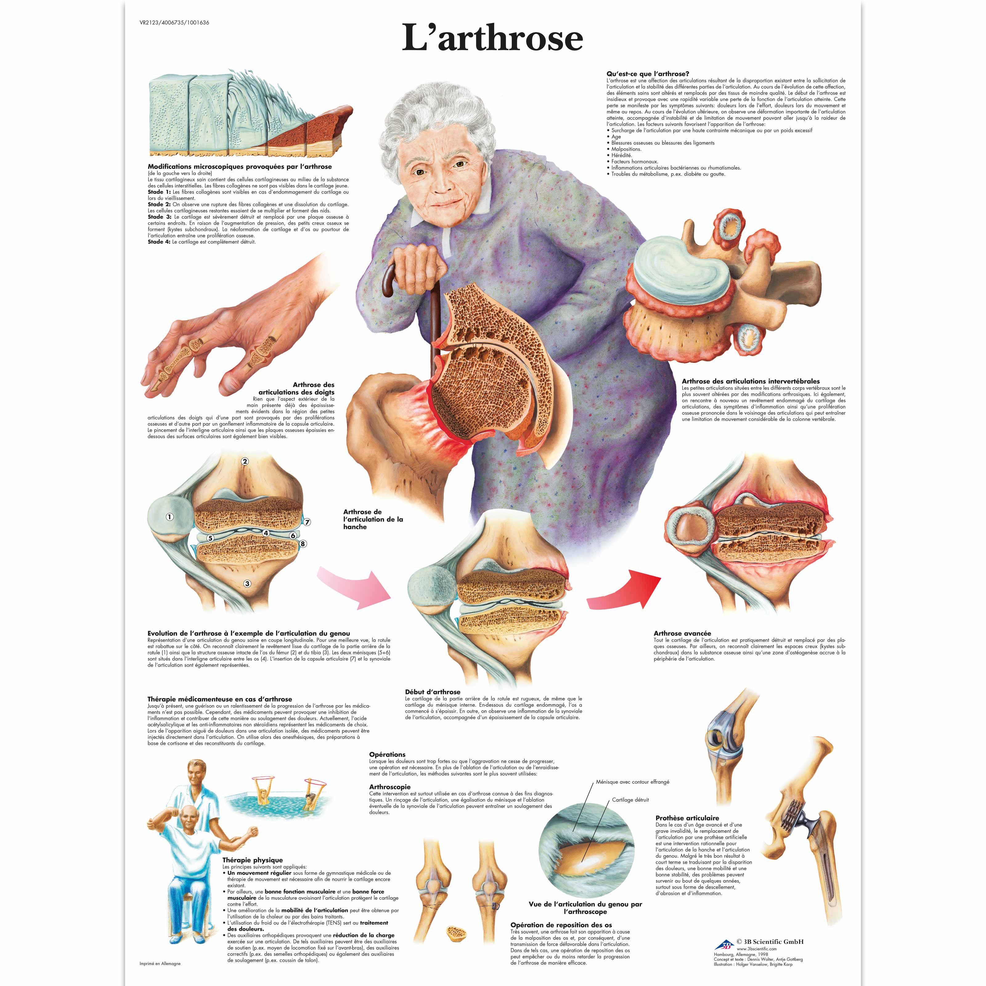 Quels sont les symptômes d'une poussée arthrosique