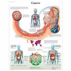 Cancer, 1001781 [VR2753L], Cancers

