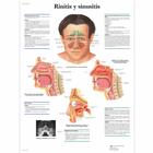 Rinitis y sinusitis, 1001833 [VR3251L], Oreille, nez et gorge