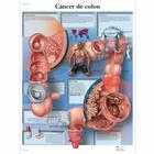  Cáncer de colon, 4006855 [VR3432UU], Cancers
