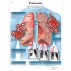  Polmonite, 4006923 [VR4326UU], Parasitaires, virales ou Infection bactérienne