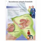 Incontinenza urinaria femminile, 4006950 [VR4542UU], Gynécologie


