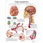 Colpo apoplettico, 4006961 [VR4627UU], système cardiovasculaire